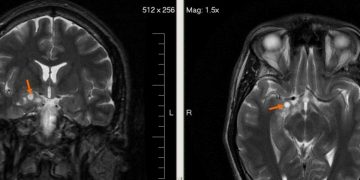 Researchers Develop AI Model That Classifies Brain Tumours With Single MRI Scan