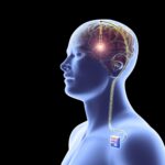 180423-brain-implant-mn-1350